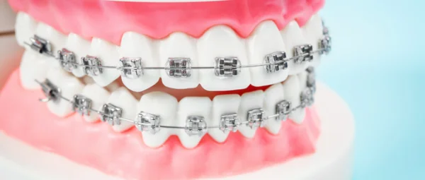 dentalcarextra functions of different parts of your braces